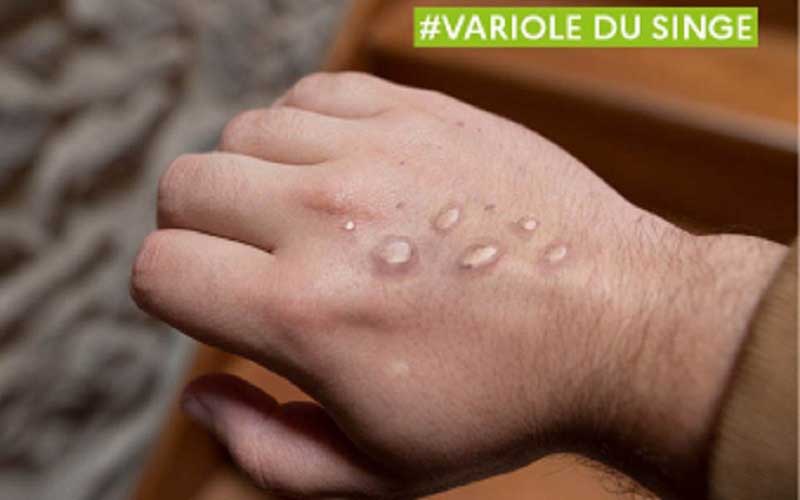 Monkeypox : prise en charge en Ile-de-France