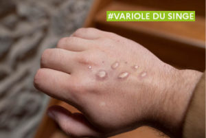 Variole du singe - Monkeypox